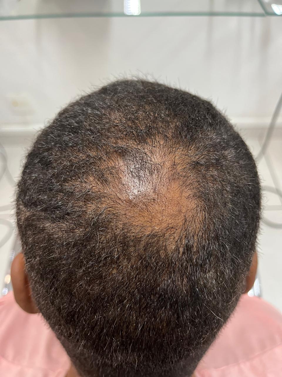 Antes do tratamento — 2 MESES DE TRATAMENTO COM A LINHA DNA VITAL
